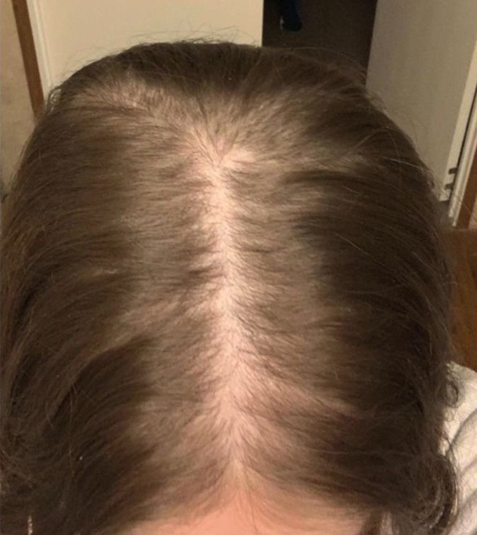 Ziua 0 — cărare lățită și scalp vizibil în creștet, înainte de rutina Regen Expert